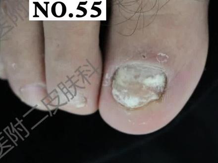 #灰指甲 看起来显老,不卫生,这个视频帮到您#医学科普