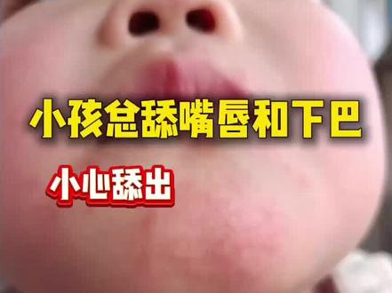 #抖音万粉扶持计划 孩子总爱舔嘴唇和下巴,一不小心就会舔出羊胡子疮。咋办呢?#科学育儿 #羊胡子疮#舔嘴唇的危害 #知识科普 #信阳市中心医院儿童保健科 @信阳市中心医院