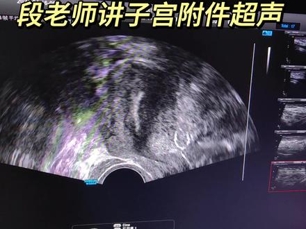 听超声医生讲解超声下的子宫和两个卵巢,两个多囊卵巢。#超声学习 #医学影像 #剖腹产后 #多囊卵巢