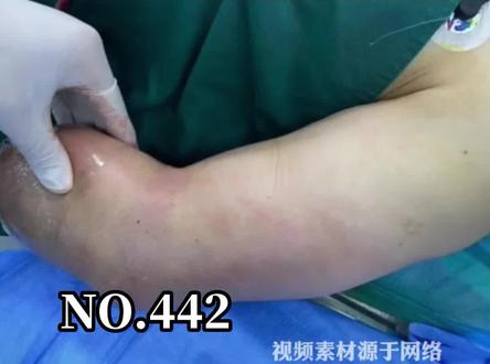 大家要记得及时处理伤口哦!#健康养生 #科普#可怕