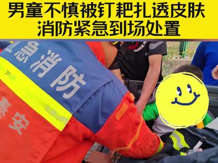 惊险!男童不慎被钉耙扎透皮肤,消防紧急到场处置#消防救援 #儿童安全 @山东消防