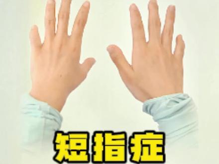 多种短指合并#短指症 #手指 #医学科普 #上海六院康庆林