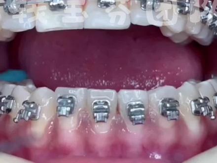 牙齿矫正中的换弓丝操作#牙齿正畸 #上海九院 #上海牙齿矫正 #口腔科普 #口腔健康