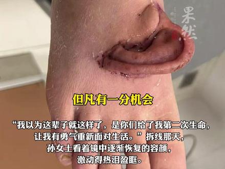 (原创)山东一女子左耳离断,被“寄养”在脚背上,5个月后 脚背上的耳朵成功“回家”