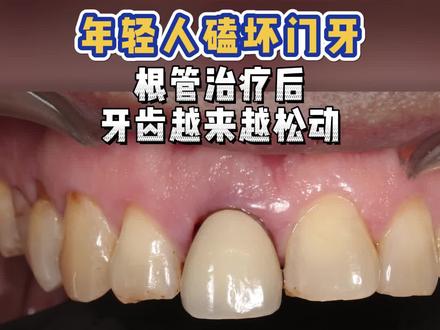 年轻人磕坏门牙,根管治疗后,牙齿越来越松动#根管治疗