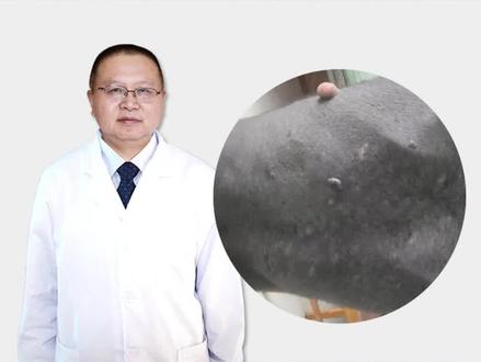 兽皮痣的下集科普也来了,讲的是怎么处理#成都 #皮肤科医生