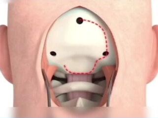 开颅取肿瘤手术,医学3D动画,有被吓到吗?#医学科普 #科普视频 #健康知识 #3D动画