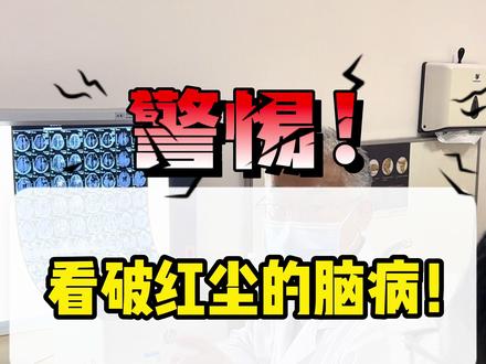 #硬核健康科普行动 警惕看破红尘的脑病!额叶病变导致的情感淡漠,一定要及时就医。#神经外科 #额叶损伤 #情绪稳定