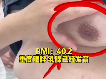 严重肥胖小伙,体重指数超过40,医生为啥推荐手术减重#肥胖 #减重手术 #缩胃减重 #男性乳腺发育症 #鼓楼医院减重