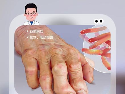 曾经让人闻风丧胆的麻风病现在还有吗#科普 #涨知识