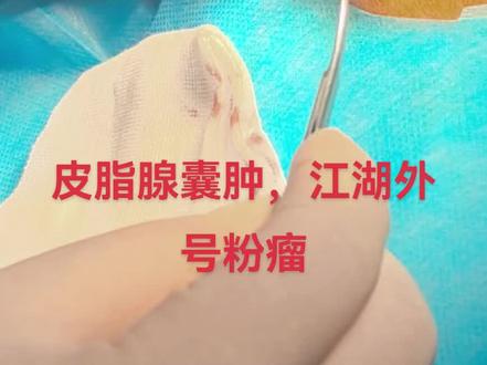 整形常规,皮脂腺囊肿张这样
#粉瘤切除 #皮脂腺囊肿