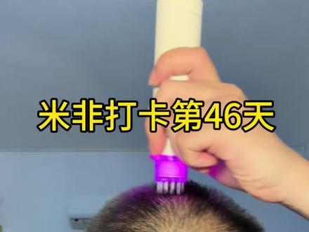 米第46天(非第45天)#非那雄胺 #米诺地尔 #脱发 #雄脱 #掉发