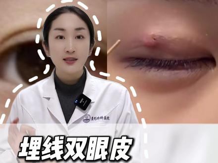 埋线双眼皮出现这三点要注意!! #八大处赵竟伊 #双眼皮 #双眼皮手术 #眼袋泪沟 #八大处
