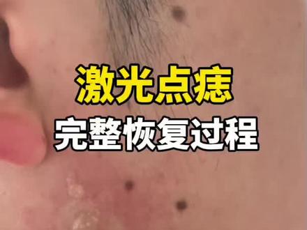 激光点痣完整恢复过程,满脸的黑痣其实很影响皮肤干净度,再确定不是病理性黑痣情况下,在去医院激光点掉,但是恢复期非常重要!也要忌口!疤痕体质要注意!
#点痣 #黑痣 #激光点痣