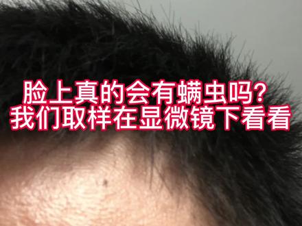 皮肤上的蠕形螨到底是什么样的#显微镜下的世界 #螨虫