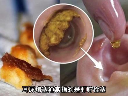 如何知道自己是否有耳屎堵塞