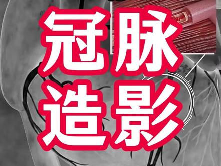 心脏冠脉造影最疼的不是打麻药,是这一步! 很多人以为插管子最疼,其实错了。
麻醉小哥告诉你:真正难受的就那几秒钟
浑身突然像烧起来一样🔥就一两秒
但忍过去就好了。
看完这个视频,你以后再也不怕做这个检查。
👇转发给家里心脏不好的长辈,他们需要知道
#冠脉造影 #心脏检查 #冠心病 #心脏造影 #冠脉介入