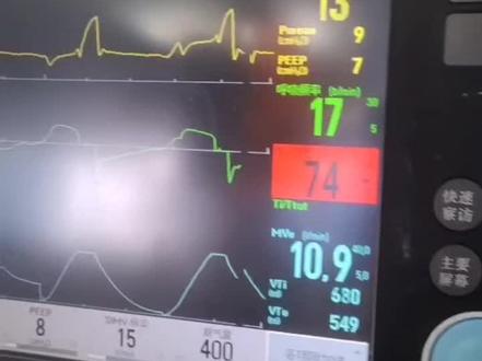 最近呼吸机全开,同时又是设置高氧浓置,注意:供氧压力是否足够?#医疗设备 #呼吸机 #医学科普