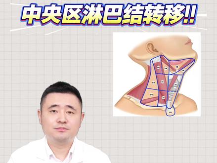 甲状腺癌中央区淋巴结转移是怎么回事?#甲状腺癌 #甲状腺结节 #淋巴结 #医学科普