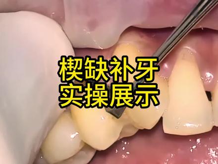 楔状缺损补牙#口腔科普 #补牙 #口腔科邓教授