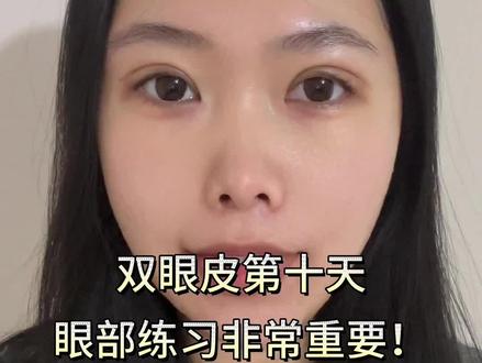 👀第十天啦 快来和我一起练习翻白眼🙄️吧!多往上看 有助于恢复噢~#双眼皮 #全切 #恢复训练