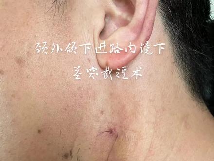 内镜下颈外颌下进路茎突截短,好多人担心疤痕问题,其实不用担心,看看这些疤痕。#茎突过长综合征 #微创手术