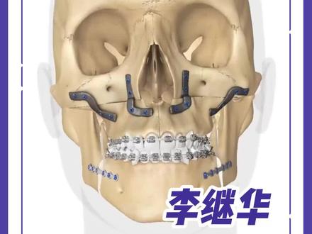 科普时间👉正颌手术风险大吗?#正颌 #医学科普#安全变美 #华西口腔
