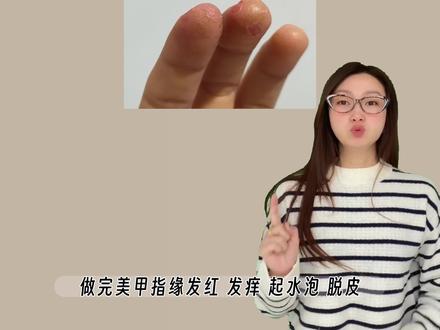 8个对策 原理美甲过敏! #极致单色 #美甲过敏 #自学美甲 #DIY美甲 #甲油胶过敏