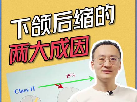 下颌后缩的两大成因
家长们关注孩子的下颌后缩问题时,需要知道有两个成因:遗传因素和环境因素。遗传因素指的是如果孩子的父母或祖辈中有一位有下颌后缩,那么孩子出现下颌后缩的可能性就会更大一些。颌骨的发育是由基因决定的。但是,即使父母下颌发育正常,孩子也可能出现下颌后缩,这是因为受到环境的各种影响,例如牙齿障碍、早期牙齿掉落、张口呼吸、吃手等不良习惯,导致下颌不能正常发育。正畸医生的任务就是通过正畸治疗,让孩子的下颌完全释放出自己的生长潜力,使其发育到正常水平。但是,如果孩子的下颌本身基因发育不好,正畸的疗效就会有限。因此,正畸不是万能的。不过,正畸医生可以让孩子的下颌尽可能地释放到其最大的生长潜力。所以,当家长发现孩子有下颌后缩问题时,不要过度担心,可以咨询正畸医生并及时治疗。同时,家长也应该注意孩子的口腔卫生和饮食习惯,避免不良习惯对孩子的下颌发育造成不良影响。
#正畸 #整牙 #牙套 #下颌后缩 #郝泽良