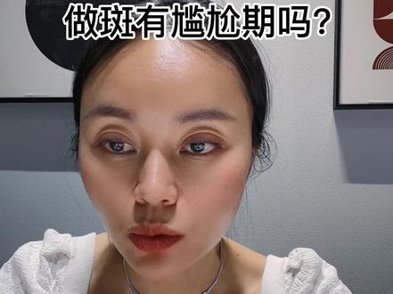 很多时候,店家为了迎合顾客,去吹捧零尴尬期做卖点。后面我想通了,尊重皮肤代谢正常原理,有尴尬期那就有,实话实说。你接受那就做,接受不了就去找别人。坚持做自己。 #祛斑有没有尴尬期#祛斑会不会脱皮屑#祛斑红