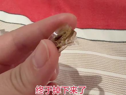 #包皮环切手术 第16天终于掉下来了😄