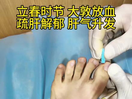 立春时节大敦放血,疏肝解郁肝气升发#立春 #疏肝解郁 #福远堂 #中医世家 #吴汉卿教授