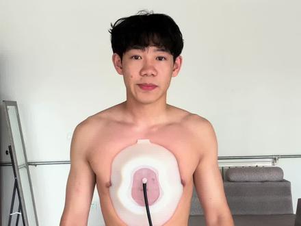 打卡142天#漏斗胸#漏斗胸吸盘 #体态纠正 #漏斗胸负压吸盘