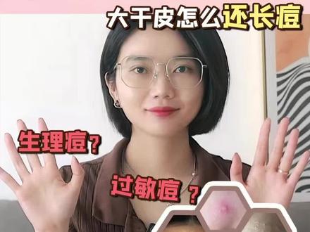 太难了‼️干皮怎么还长痘‼️理论干货篇‼️#告别痘痘肌 #抗痘