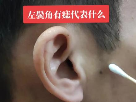 左边鬓角有痣代表什么#痣#痣的含义 #痣