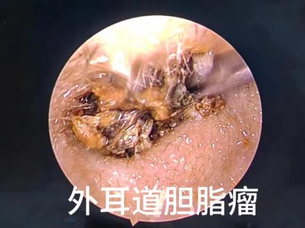 关注耳朵健康,别忽视耳屎。