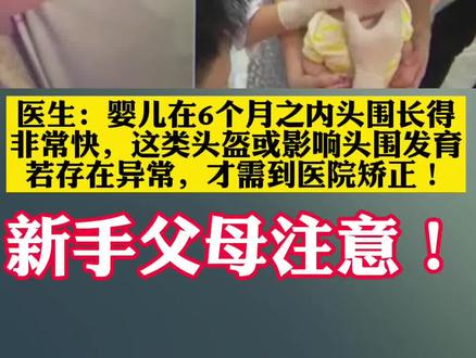 新手父母注意!#网红矫正头盔或影响婴儿发