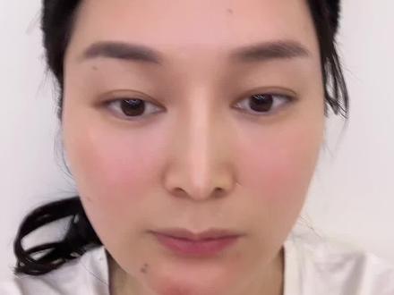 #隆鼻 我自己的鼻子,膨体耳软骨9年
歪了、塌了、鼻尖发白,随时可能穿孔
干医美这么久,见过太多修复
今天用自己的脸给大家提个醒
假体不是终身保险
移位、顶穿、感染,都是滞后风险
想变美先懂风险,别拿脸赌运气
#医美真相 #隆鼻避雷 #假体隆鼻危害