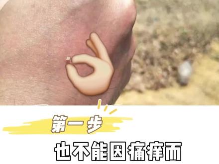 秋蜂猛于虎,被蜇了该怎么做?急诊科护士长教你正确处理方法