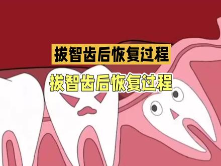 拔智齿后的疼痛管理#拔智齿 #口腔科普