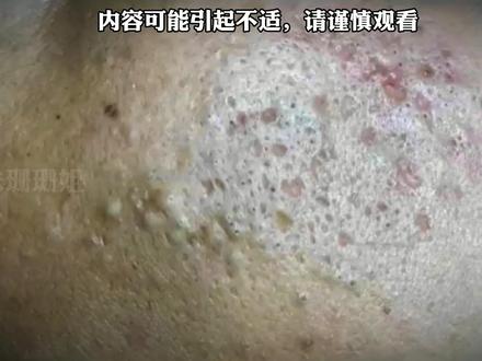 宝子们这期格外的饱满#护肤 #痘痘黑头粉刺拜拜 #细胞夹面部清理工具 #深层毛孔清洁 #解压