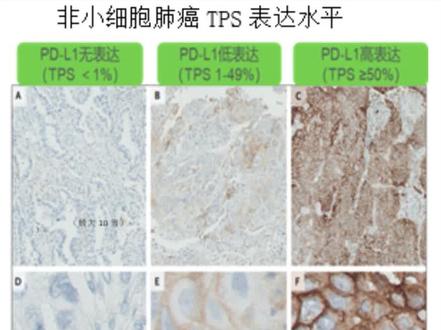 KEYNOTE189研究显示:PD-L1不同表达水平均可从免疫联合化疗中带来生存获益,PD-L1表达越高,五年生存率越高,免疫要尽早应用。#医学科普 #关注健康关注我