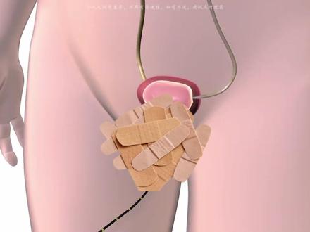 肾结石手术的全过程,平时一定要多喝水啊! #肾结石微创手术