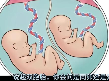 这位22岁的宝妈自然怀了很罕见的双胞胎,单绒单羊双胞胎,大约只有三千万分之一不到的几率可能出现。对于孕妇来说,妊娠的风险太大,临床上成功出生的机率比较低,我院产科、新生儿科、手术室通力合作,两个男宝宝最后成功分娩,母子仨平安……#单绒单羊双胞胎 #迎接新生命 #自然怀孕双胞胎