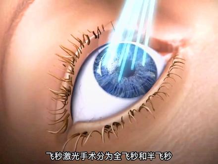 飞秒激光原理,全飞秒和半飞秒有何区别?#科普 #涨知识 #飞秒