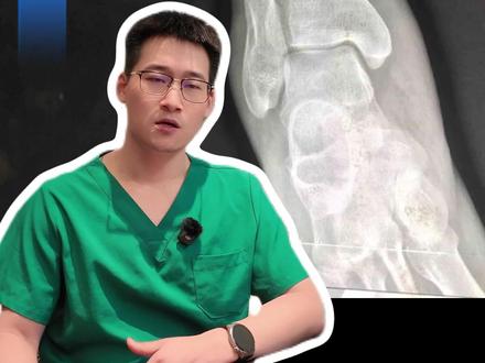 小腿骨折后多久可以多久可以正常走路? 小腿骨折后多久可以多久可以正常走路?#小腿骨折 #骨折 #骨折恢复记录 #康复运动 #康复训练