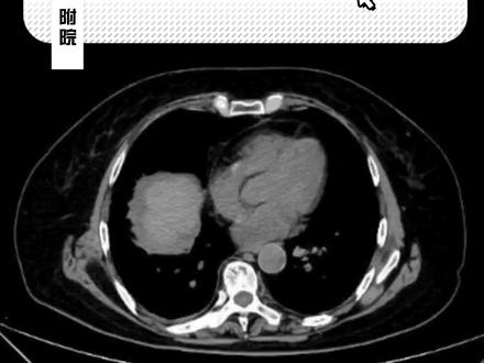 3月4日 (1)右膈下脓肿穿刺引流 #肝脓肿 #膈下脓肿 #术后发热 #超声介入 #超声影像