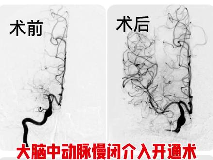中年女性大脑中动脉闭塞脑梗死,错过静脉溶栓及动脉取栓,行慢性闭塞介入开通手术。#脑血管闭塞 #脑梗死 #神经介入 #医学科普 #脑血管狭窄