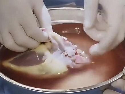 50岁的心脏移植到27岁小伙身上,能够存活多久