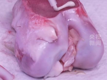 断骨黏合只需3分钟!我国自主研发“骨02”胶水,未来打一针可实现骨黏合。目前已完成临床150余例病人骨折治疗。(总台记者 王建帆 刘浪 @浙江卫视 )